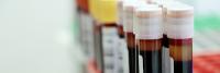 Blood samples in a test tube rack